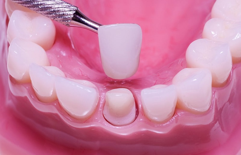 Bọc răng sứ tiếng Anh là Dental porcelain chính là tên của loại hình nha khoa thẩm mỹ này