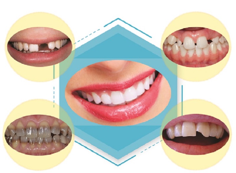 Làm răng sứ giúp giải quyết các khuyết điểm của răng