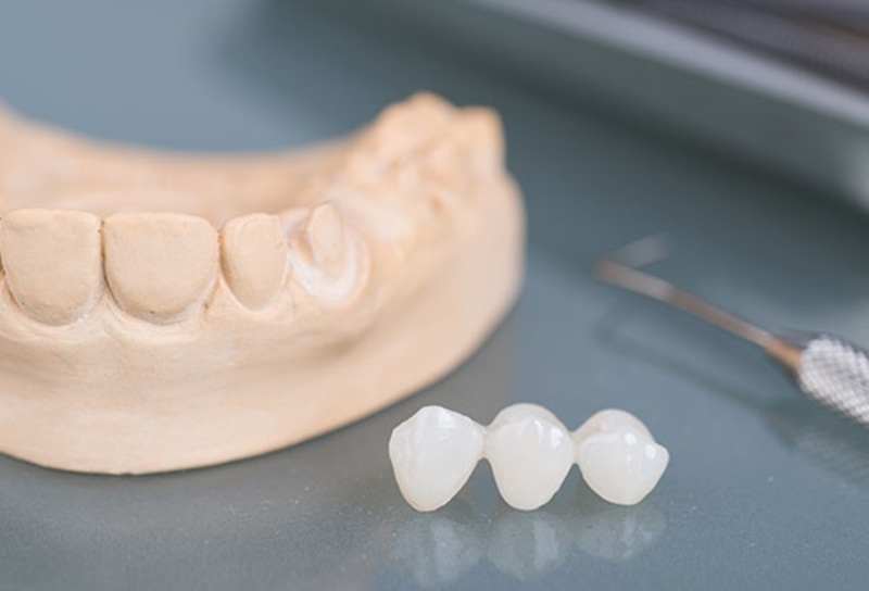 Việc bọc răng sứ còn dựa vào nhiều yếu tố khác nhau