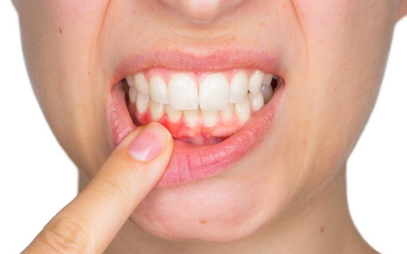 Viêm nha chu tưởng chừng đơn giản nhưng tiềm ẩn rất nhiều mối nguy hại cho răng
