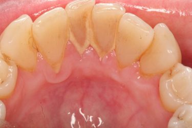 Lấy cao răng là gì? Quy trình thực hiện và lưu ý cần nhớ