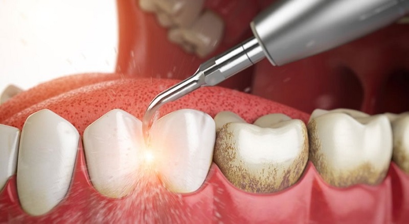 Lấy cao răng đóng vai trò rất quan trọng đối với sức khỏe răng miệng