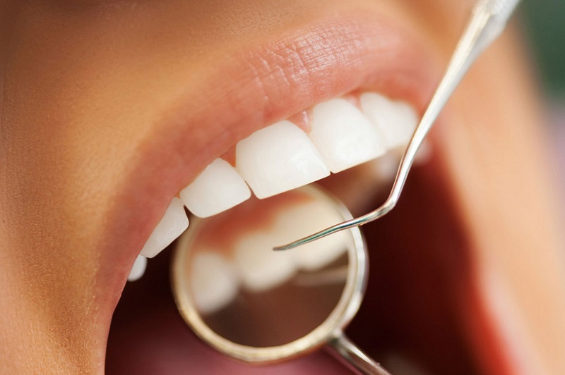 Lây vôi răng cũng không gây đau đớn, khó chịu