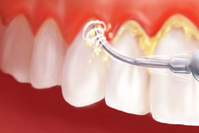 Lấy cao răng là một thủ thuật nha khoa đơn giản được thực hiện rất nhiều