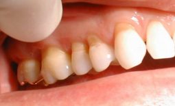 Bổ sung quá nhiều thực phẩm chứa acid gây ra hiện tượng mòn men răng