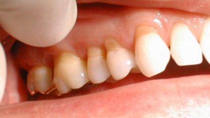 Bổ sung quá nhiều thực phẩm chứa acid gây ra hiện tượng mòn men răng
