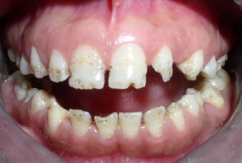 Thiếu sản men răng là căn bệnh phổ biến ở trẻ em và người lớn tuổi