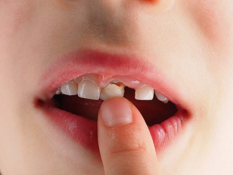 Răng sữa là những chiếc răng đầu tiên mọc lên khi bé bắt đầu bước vào thời kỳ ăn dặm