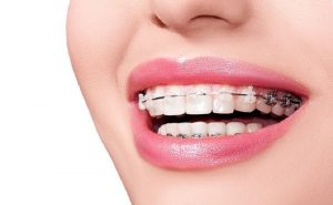 Niềng răng là một thuật ngữ được sử dụng trong nha khoa