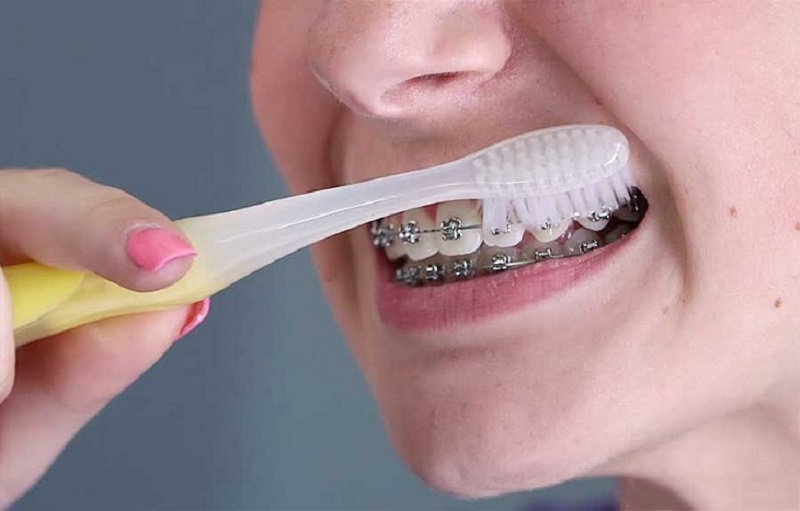 Vệ sinh răng miệng thường xuyên bằng bằng chải chuyên dụng