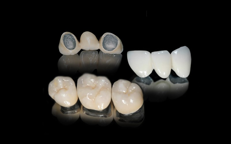 Răng sứ kim loại thường có chi phí thấp
