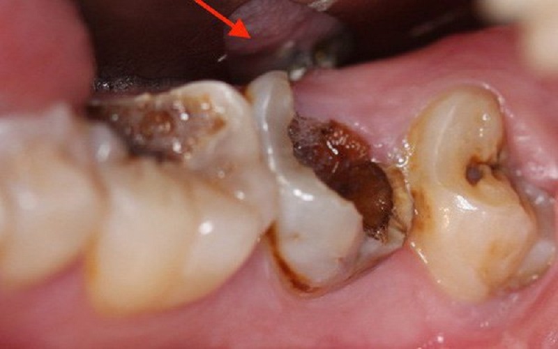 Quan sát bằng mắt thường thấy ngà răng, men răng bị tổn thương