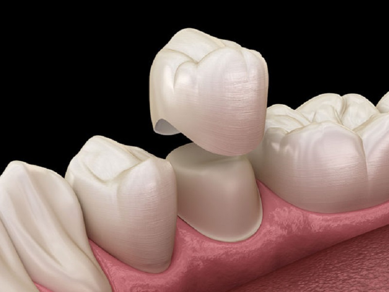 Bọc răng sứ được chỉ định cho trường hợp bệnh nhân bị răng sâu mức độ nặng