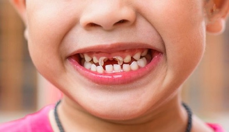 Trẻ nhỏ có nguy cơ bị sâu răng cao