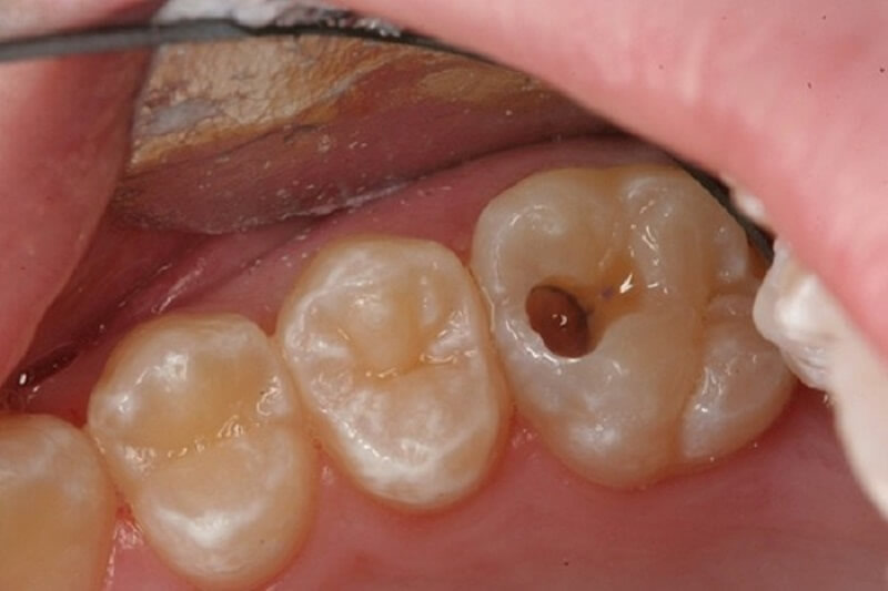Thông qua hình ảnh sâu răng sẽ thấy với mức độ nhẹ trên bề mặt răng sẽ có chấm đen