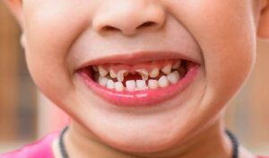 Trẻ bị sún răng sữa thường không có triệu chứng đau nhức