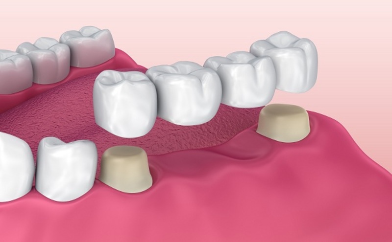 Phương pháp được áp dụng khi bạn bị mất một vài răng hoặc răng liền kề nhau