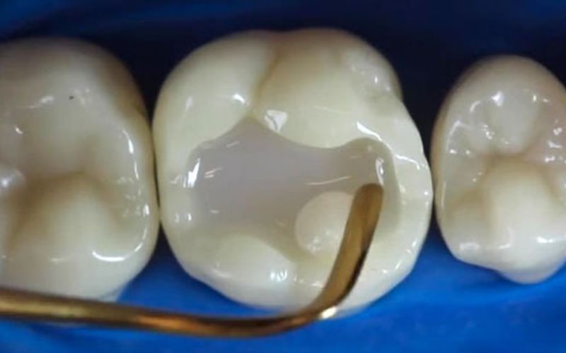 Trám răng là một trong những phương pháp trị sâu răng hiệu quả tại nha khoa