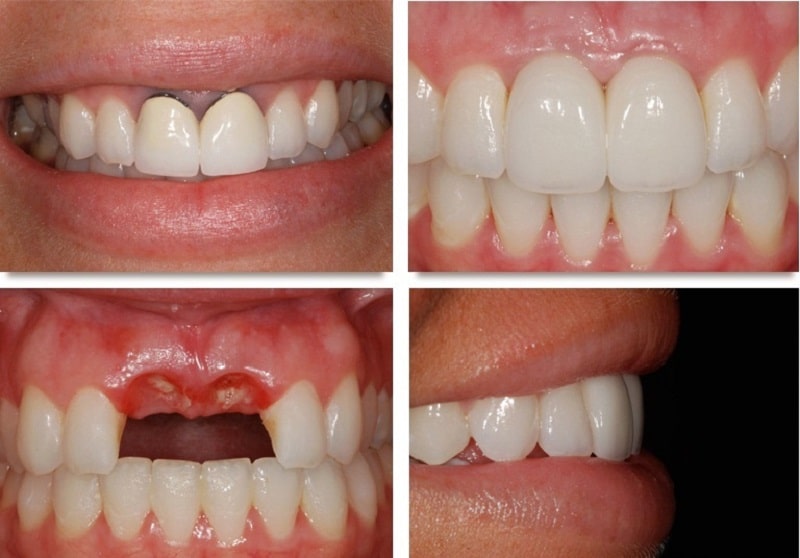 Trồng răng giả là hình thức thẩm mỹ nha khoa được áp dụng nhiều hiện nay