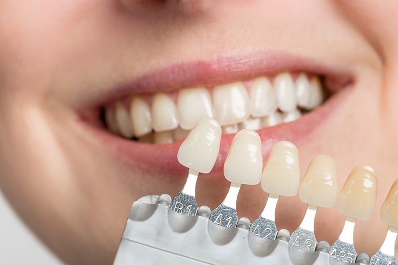 Trồng răng vẫn đảm bảo tính thẩm mỹ rất cao
