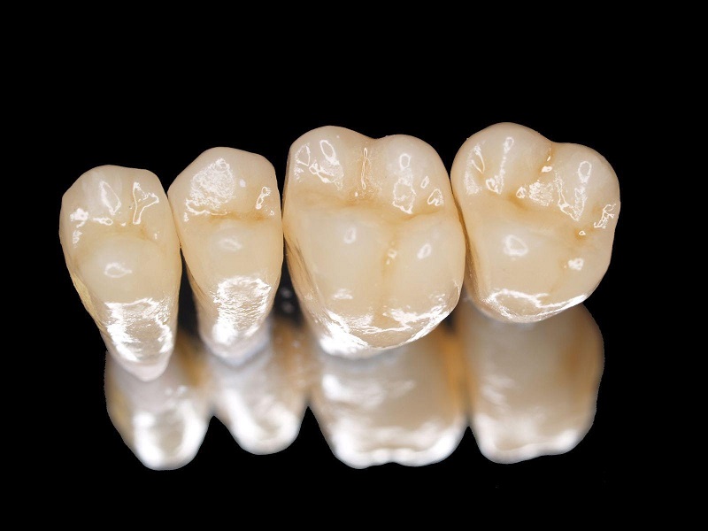 Răng sứ kim loại cũng có hại loại khác nhau