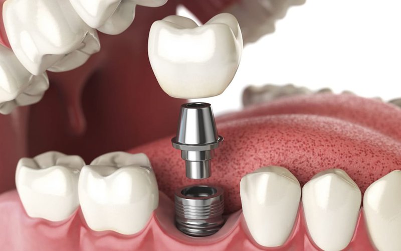 Trồng răng công nghệ Implant hiện đại và cao cấp nhất