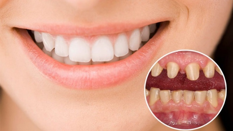 Trồng răng giả đặc biệt quan trọng để đảm bảo chức năng răng miệng