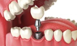 Răng Implant được cấu tạo với 3 bộ phận chính gồm có trụ Implant, mão răng sứ và đầu kết nối Abutment