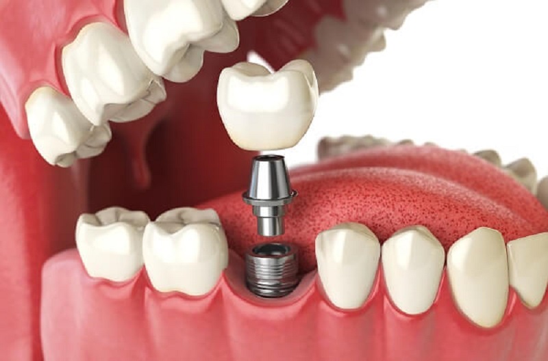 Răng Implant được cấu tạo với 3 bộ phận chính gồm có trụ Implant, mão răng sứ và đầu kết nối Abutment Răng Implant được cấu tạo với 3 bộ phận chính gồm có trụ Implant, mão răng sứ và đầu kết nối Abutment