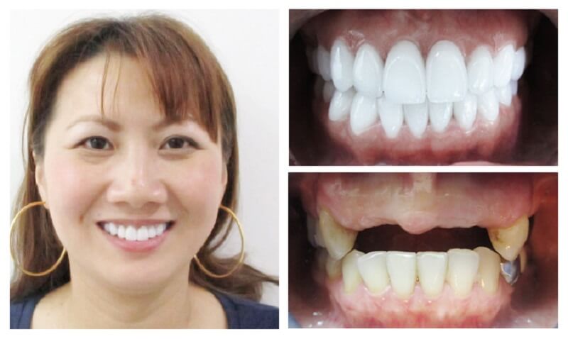 Tìm hiểu điều kiện để thực hiện trồng răng Tìm hiểu điều kiện để thực hiện trồng răng