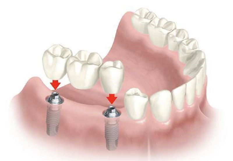 Bác sĩ sẽ thực hiện mài 2 răng thật ở 2 bên để làm trụ răng Bác sĩ sẽ thực hiện mài 2 răng thật ở 2 bên để làm trụ răng