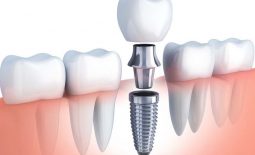 Cấy ghép implant được coi là phương pháp trồng răng trong cùng tối ưu nhất
