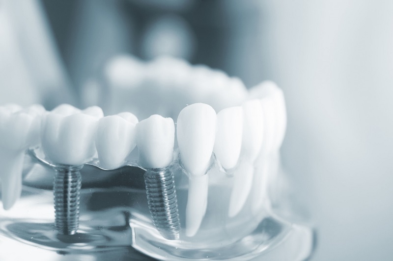 Trồng răng implant được nhiều người lựa chọn hiện nay