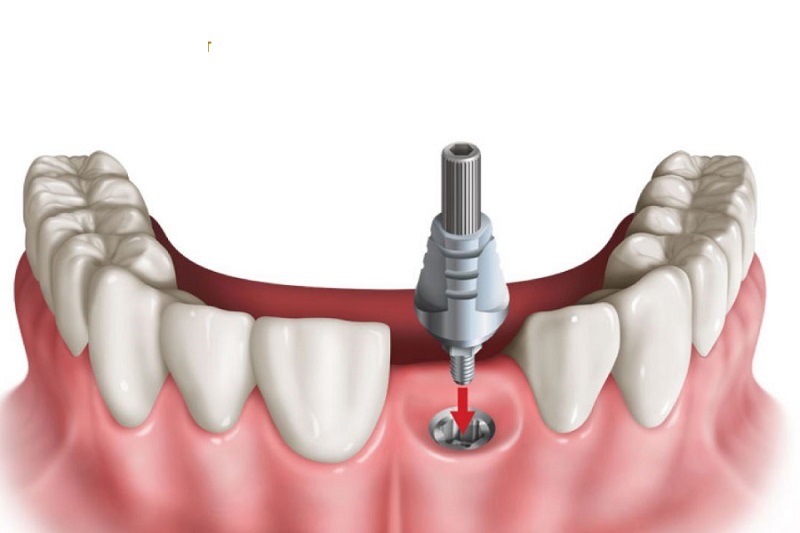 Trồng răng bằng trụ implant chỉ gây đau đớn sau khi hết thuốc tê