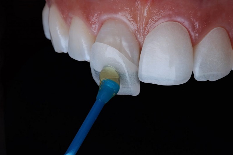Trồng răng nanh bằng phương pháp đắp mặt sứ