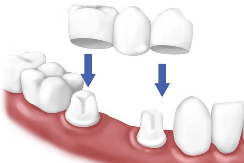 ha sĩ sẽ dùng cầu răng tạo điểm tựa giúp cho phần răng bị mất được lấp đầy