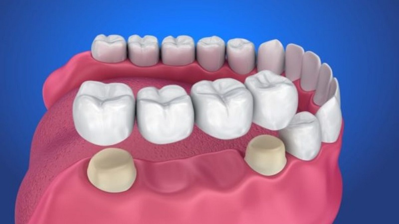 Phương pháp cầu răng sứ được nhiều người áp dụng