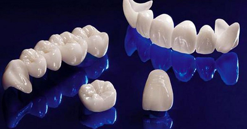 Răng toàn sứ cho chất lượng và tuổi thọ cao nhất