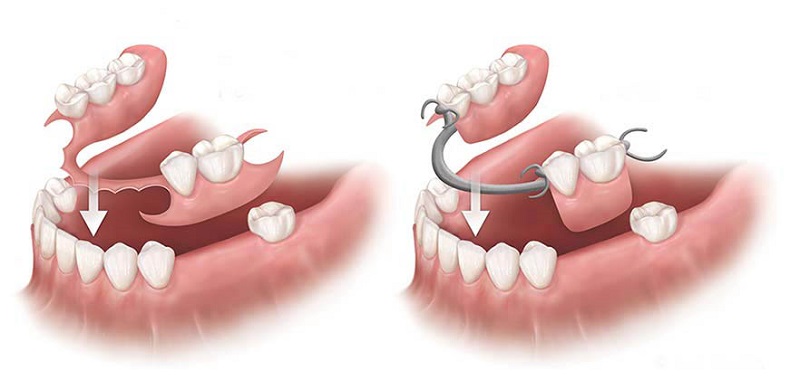 Răng sứ sử dụng hàm giả
