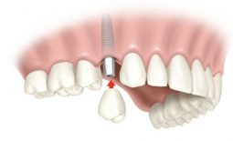 Việc trồng răng sứ giúp cải thiện chức năng ăn nhai