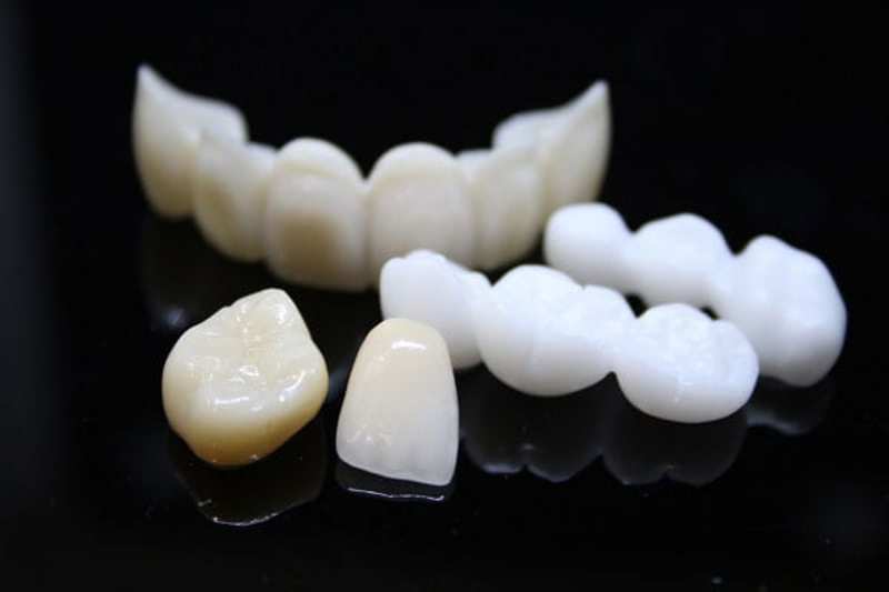 Răng sứ Emax mang tính thẩm mỹ cao giống với răng thật