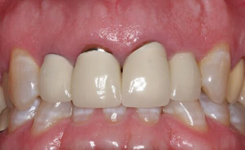 Trong một số trường hợp bị ảnh hưởng xấu khi trồng răng