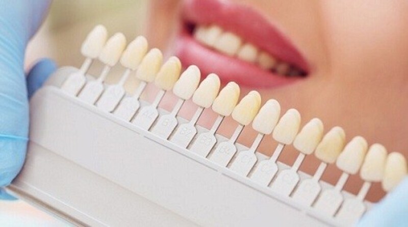 Cần phải tìm hiểu về quy trình trồng răng