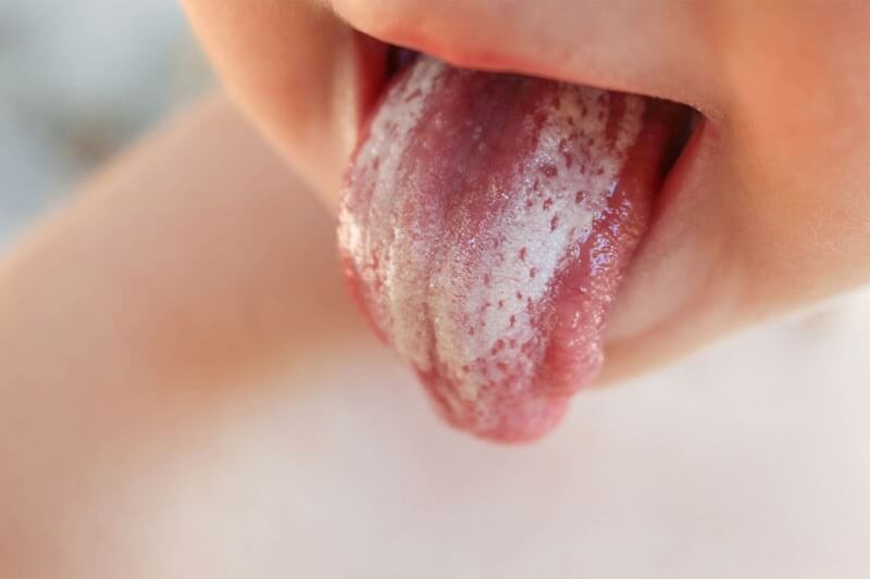 Tưa miệng được hiểu là sự phát triển của vi khuẩn nấm Candida Albicans gây nên