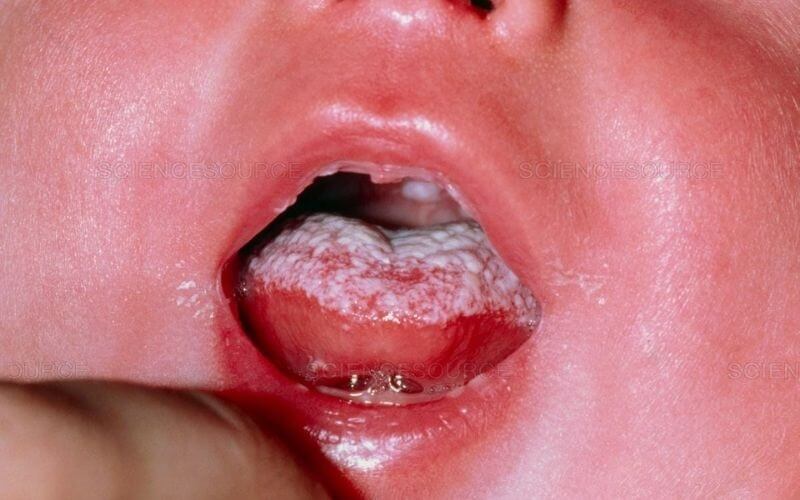 Trên đầu lưỡi của trẻ nhỏ thường xuất hiện các chấm trắng khá nhiều