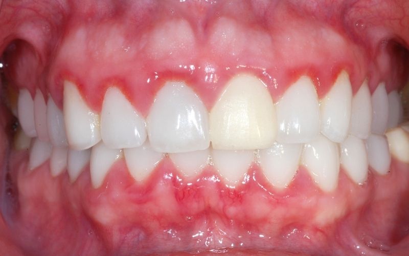 Tình trạng viêm nhiễm nặng xuất hiện ở chân răng