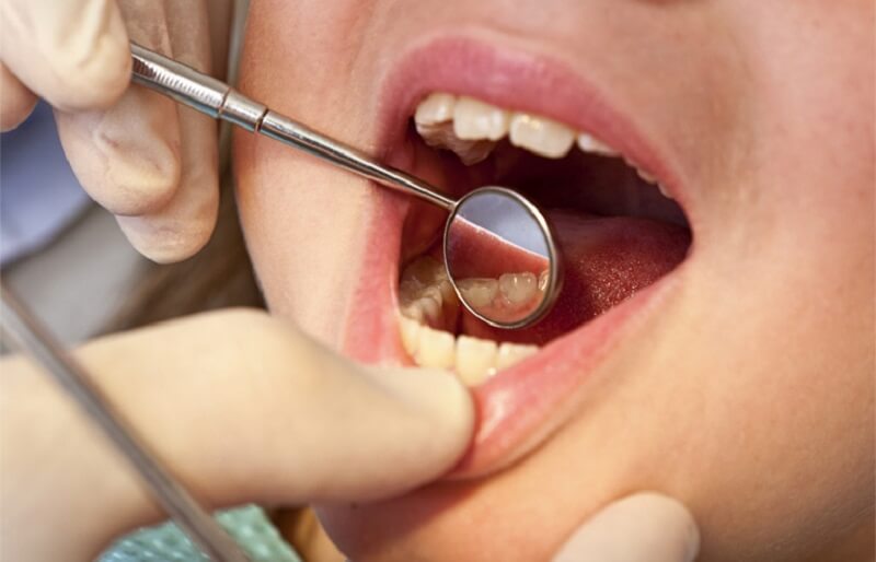 Việc loại bỏ cao răng sẽ giúp tiêu diệt vi khuẩn và tác nhân gây ra bệnh