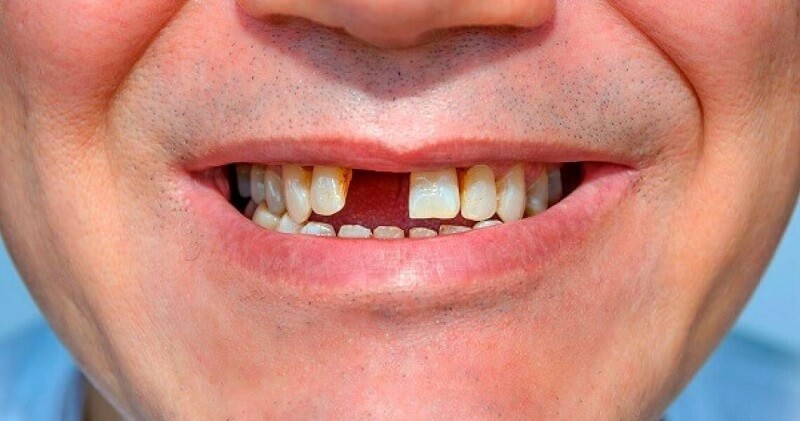 Bệnh nha chu có thể gây ra hiện tượng mất răng