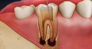 Viêm tủy răng là hiện tượng khu vực mô quanh chân răng, tủy răng bị viêm nhiễm