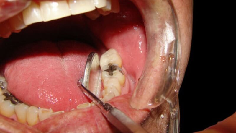 Tủy răng bị viêm gây ra các cơn đau thường dai dẳng, khá nặng và kéo dài trong vài giờ